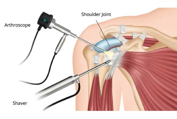 Shoulder Surgery