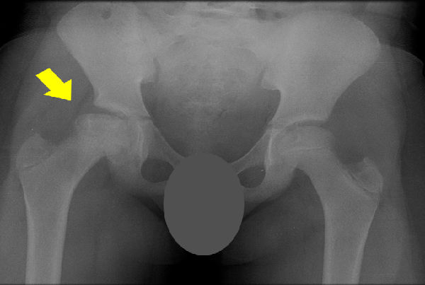 A vascular Necrosis of Hip joint