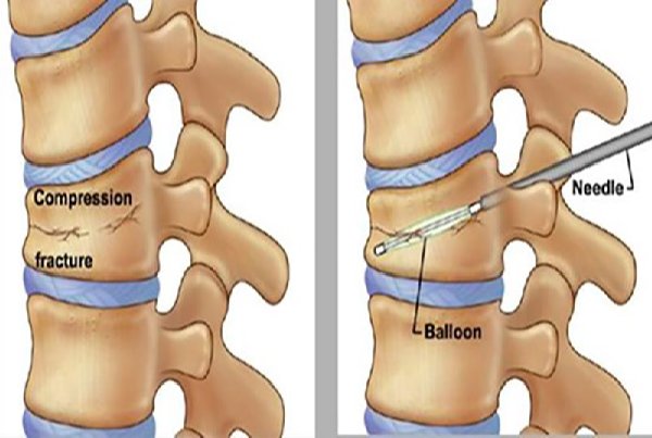 Kyphoplasty