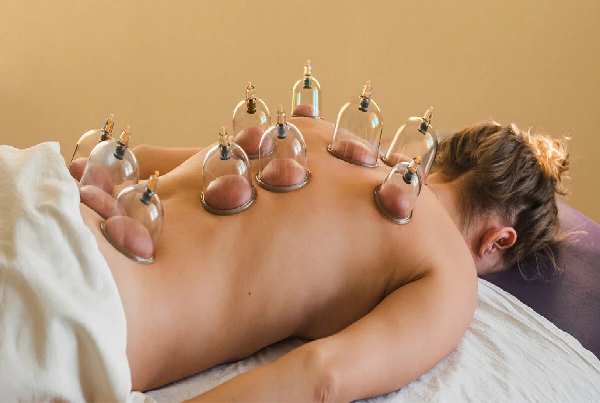 Cupping Therapy