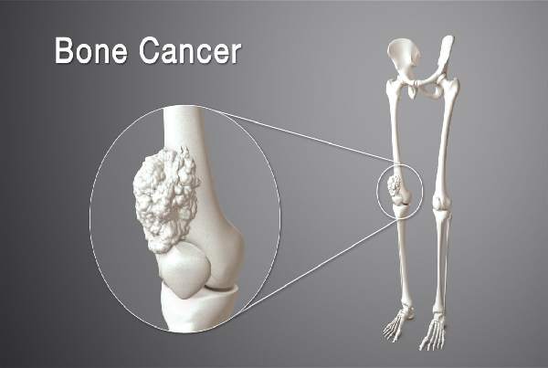 Bone Tumors