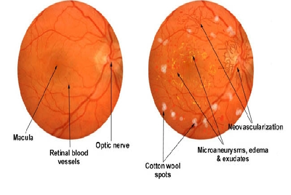 Diabetic retinopathy Screening