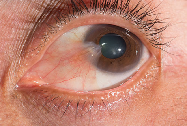 Pterygium  Surgery