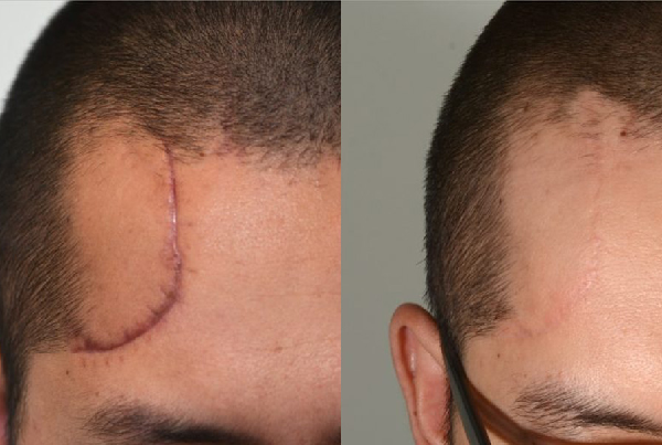 Scar Surgery