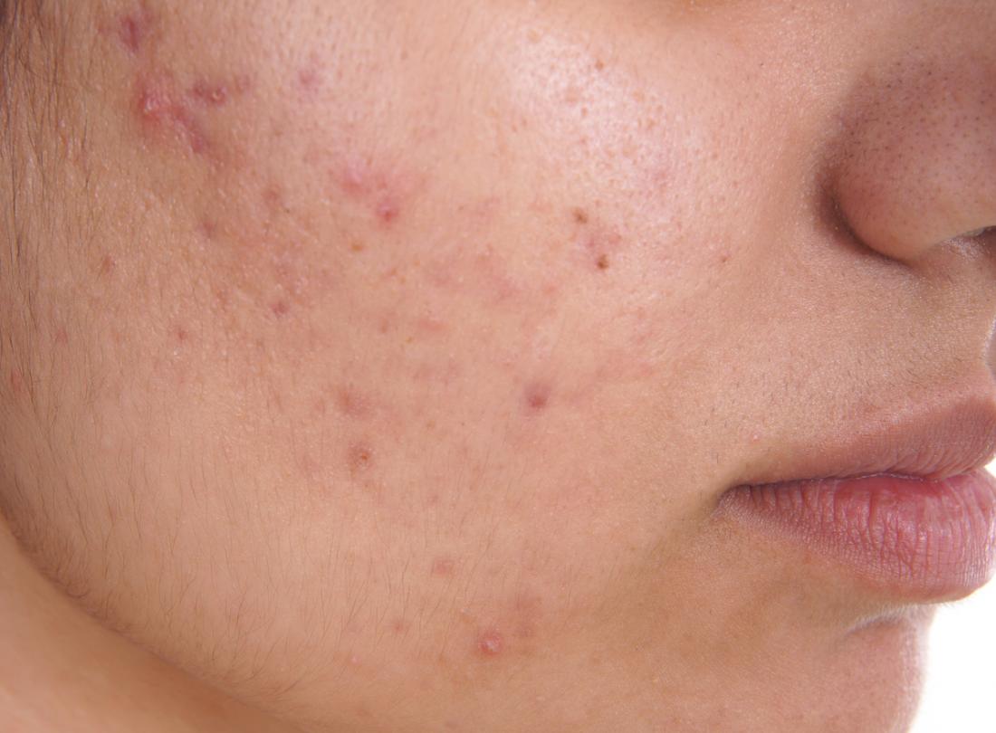 Best Acne Treatment Clinic